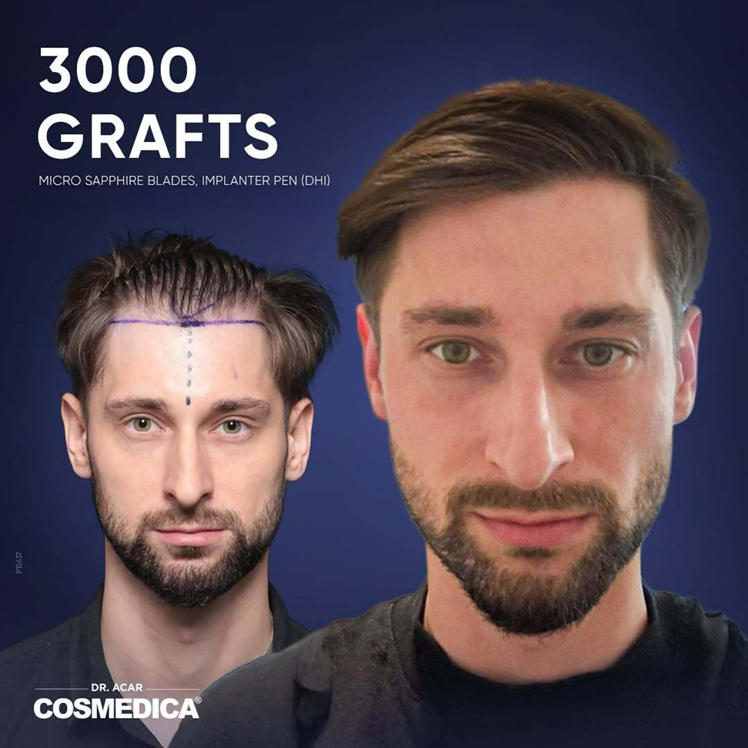 greffe cheveux avant apr&Atilde;&uml;s