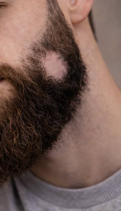 trou barbe alop&Atilde;&copy;cie