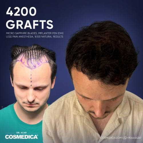 greffe de cheveux en turquie