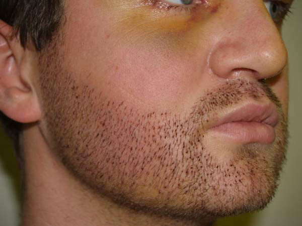 Je perds mes poils de barbe : que faire ? - BIG Blog