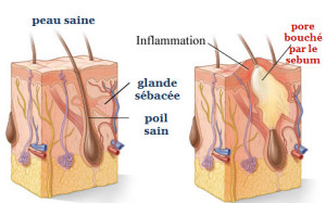 exces de sebum homme